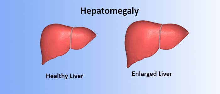 What is Hepatomegaly &#8211; Enlargement of Liver